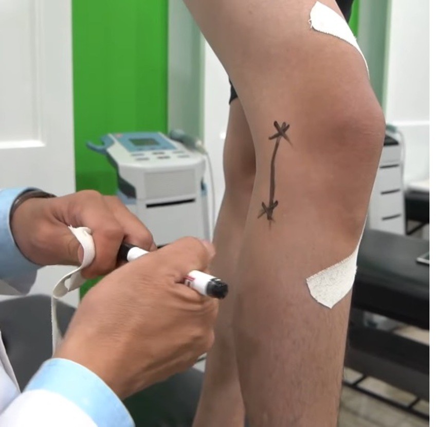 Đánh dấu các điểm dây chằng cần băng bó - Nguồn: Internet